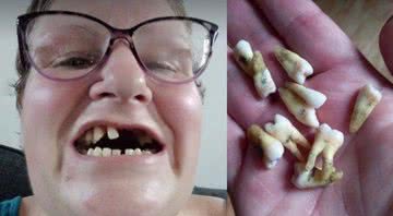 Britânica mostra boca e dentes removidos em montagem - Divulgação / Danielle Watts