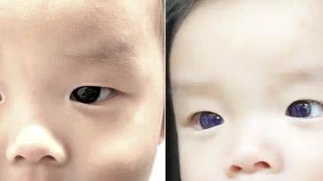 A alteração na cor dos olhos do menino - Reprodução/Jiravisitkul et al, Frontiers in Pediatrics 2023