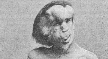 A face de Joseph Merrick - Wikimedia Commons