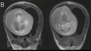 Tomografia de menina chinesa que tinha feto gêmeo parasita no cérebro - Reprodução/Zongze Li et.al