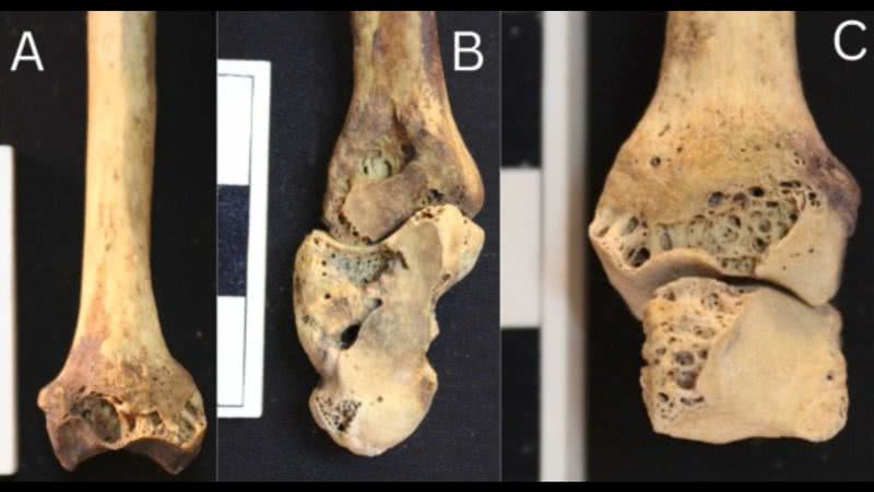 Lesões ósseas causadas por artrite no esqueleto encontrado no Egito - Divulgação/M. Mant, et al