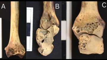 Lesões ósseas causadas por artrite no esqueleto encontrado no Egito - Divulgação/M. Mant, et al