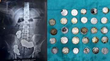 Montagem mostrando imagem de raio-X, e moedas que foram retiradas do corpo do homem - Divulgação/ Hospital Sir Ganga Ram