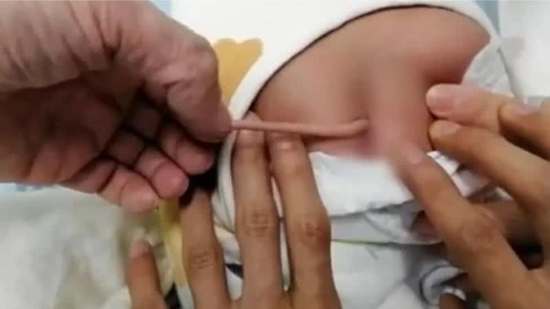 Bebê que nasceu com 'cauda' na China - Divulgação/vídeo/Metro
