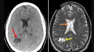 Imagens de exames cerebrais do homem - Divulgação/ American Journal of Case Reports