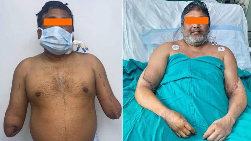 Raj Kumar antes e depois do procedimento - Divulgação/ Sir Ganga Ram Hospital