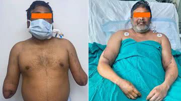 Raj Kumar antes e depois do procedimento - Divulgação/ Sir Ganga Ram Hospital