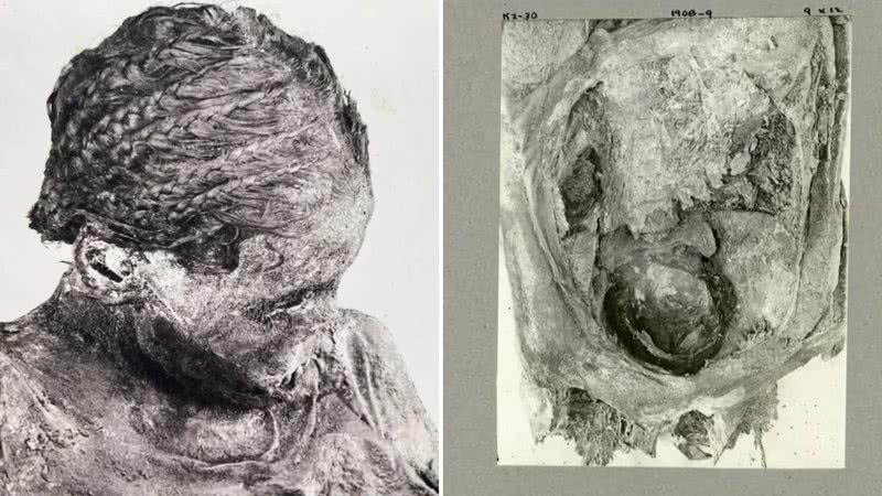 Cabeça da múmia, agora desaparecida, e cabeça de um feto na cavidade pélvica - Margolis e Hunt