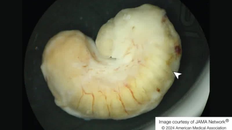 Fotografia do parasita depois de removido do olho da mulher - Divulgação/JAMA Network® © 2024 American Medical Association