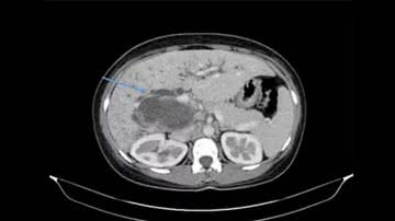 Médicos encontraram cistos de tênia no fígado da paciente - Divulgação/American Journal of Case Reports