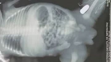 Raio-x mostra bala alojada na perna de bebê - Reprodução via TV Globo