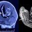 Imagens de ressonância detectaram um feto no cérebro do bebê