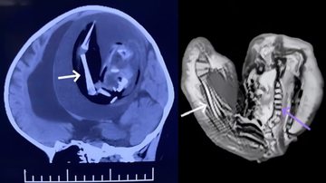 Imagens de ressonância detectaram um feto no cérebro do bebê - Divulgação