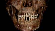 Dentes de Anne d'Alègre, a mulher com o aparelho de ouro - Divulgação/Journal of Archaeological Science: Reports/Rozenn Colleter