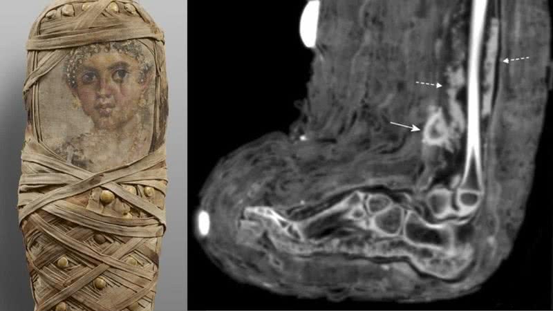 Fotografia da múmia (à esq) e imagem computadorizada de seu pé (à dir) - Divulgação/ International Journal of Paleopathology