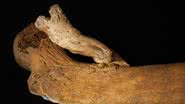 O osso que cresceu fora de lugar, saindo do fêmur do esqueleto feminino encontrado em Portugal - Divulgação/Sandra Assis