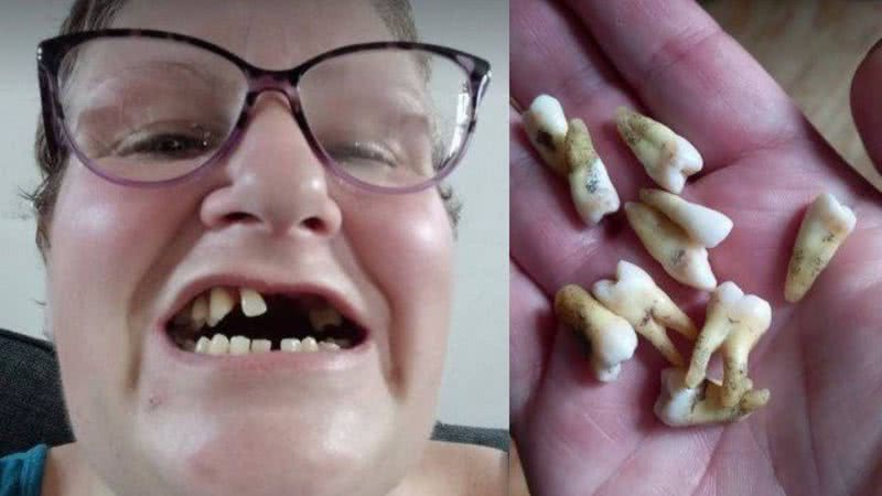 Britânica mostra boca e dentes removidos em montagem - Divulgação / Danielle Watts