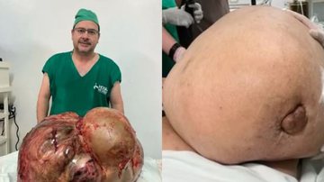 Á esquerda imagem de médico com o tumor e à direita tumor no momento da cirurgia - Reprodução/Arquivo pessoal / Reprodução/Vídeo/UOL