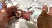 O bebê na UTI logo após o nascimento - Reprodução