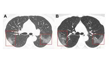 Imagem do antes e depois dos pulmões do paciente do Coronavírus - Junqiang Lei, Junfeng Li, Xun Li, and Xiaolong Qi