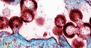 Células humanas infectadas pelo HIV - Divulgação/Instituto Nacional de Alergia e Doenças Infecciosas/National Institutes of Health