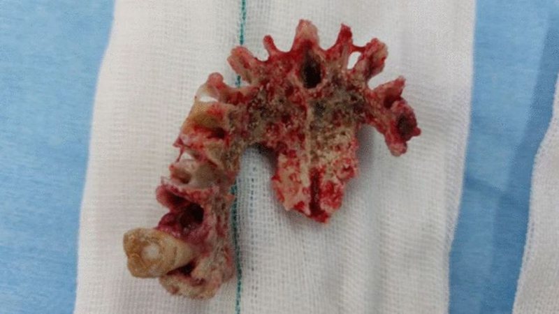 Pedaço de carne infectada retirado da boca do homem - Divulgação/ Journal of Medical Case Reports