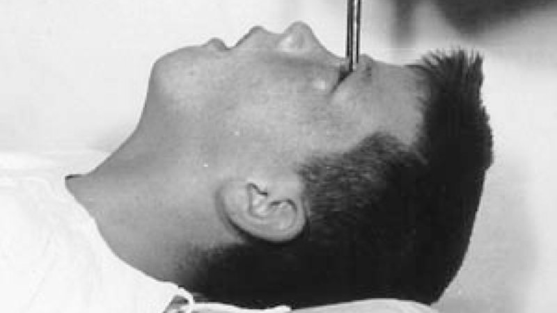 Howard Dully durante o procedimento - Divulgação