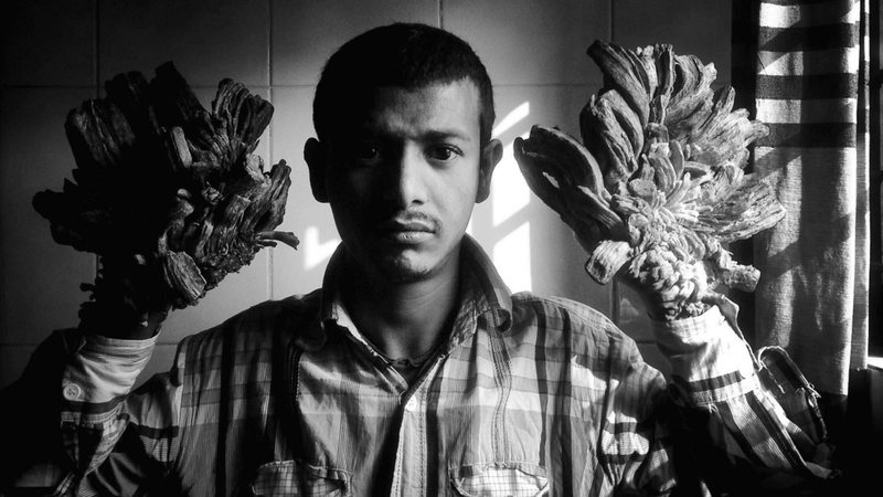 Abul Bajandar que sofre com a Síndrome do Homem Árvore - Monirul Alam via Wikimedia Commons