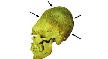 Crânio de mulher adulta deformado - Divulgação