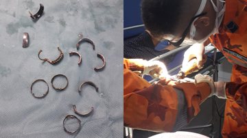 Imagens dos anéis removidos e do momento em que procedimento de remoção era feito - Reprodução/Corpo de Bombeiros do Ceará