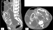 Imagens de raios X do feto calcificado no abdômen da mulher - Divulgação/Wassem Sous et. al/BMC Women's Health
