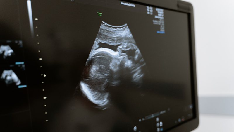 Imagem ilustrativa de ultrassom de bebê - MART PRODUCTION/Pexels