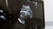 Imagem ilustrativa de ultrassom de bebê - MART PRODUCTION/Pexels