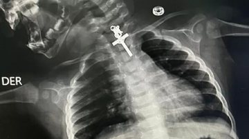 Imagem de raio-X do jovem paciente - Divulgação/ EsSalud