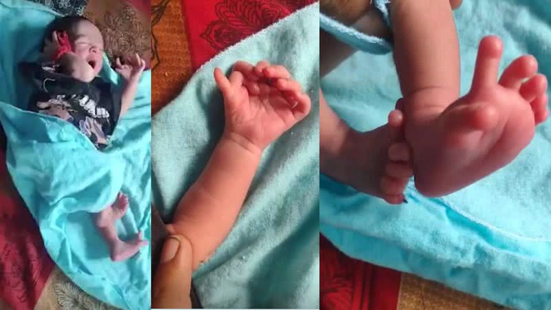 Montagem mostrando fotos do bebê com a anomalia - Divulgação/ Arquivo Pessoal
