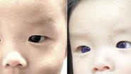 A alteração na cor dos olhos do menino - Reprodução/Jiravisitkul et al, Frontiers in Pediatrics 2023
