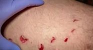 Mordida de tubarão branco na perna de homem - Divulgação/YouTube/KPIX CBS SF Bay Area