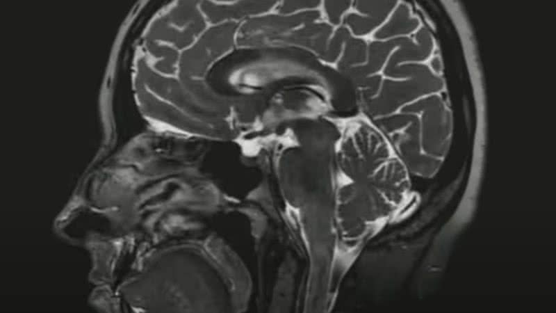 Exame médico mostra cérebro - Divulgação/Youtube/9 News Australia