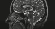 Exame médico mostra cérebro - Divulgação/Youtube/9 News Australia
