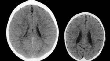 Imagem ilustra dois cérebros em análise computadorizada - Divulgação / Texas Children's Hospital