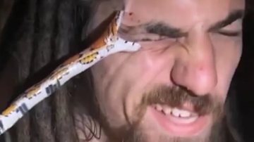 Tom White mordido no olho por cobra - Divulgação/Instagram/@world_of_snakes