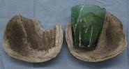 Copo e pedras encontradas na bexiga da paciente - Reprodução/Ahmed Chaabouni