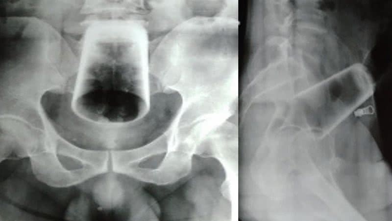 Fotografias de raio-X do paciente - Divulgação/ Journal of Nepal Medical Association