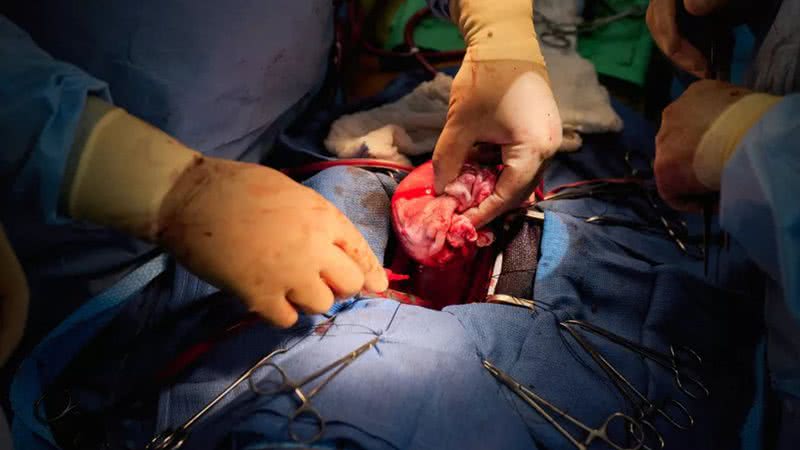 Transplante de coração de porco em paciente nos EUA - Divulgação / NYU Langone Health
