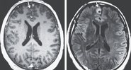 Imagem de ressonância magnética da cabeça do paciente - Divulgação / Massachusetts Medical Society