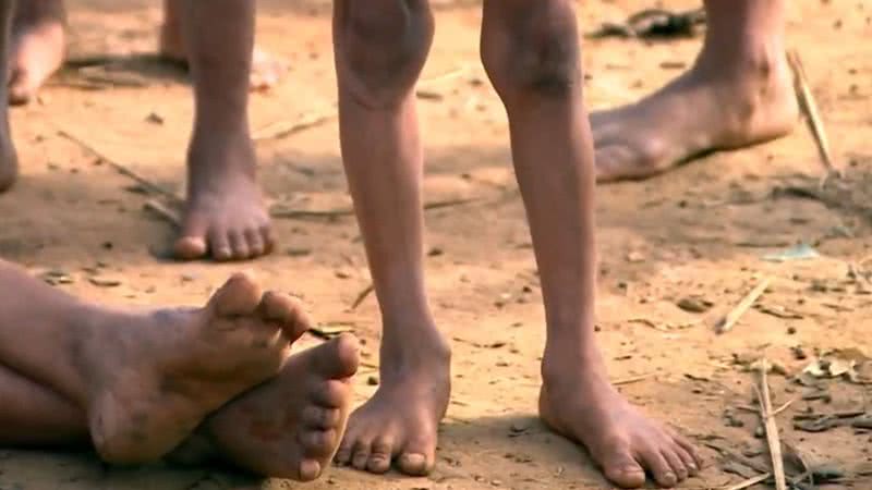Pernas de crianças yanomami com desnutrição - Divulgação / vídeo / TV Globo