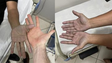 Paciente foi até o hospital por estar com as mãos azuis - Divulgação / Twitter