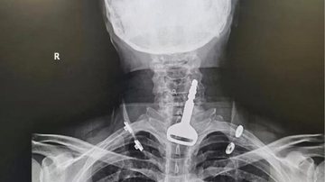 Raio-X de paciente que engoliu chave - Divulgação / Ministério da Saúde