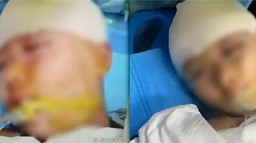 Menina de 9 anos sofreu traumatismo craniano - Divulgação/Weibo
