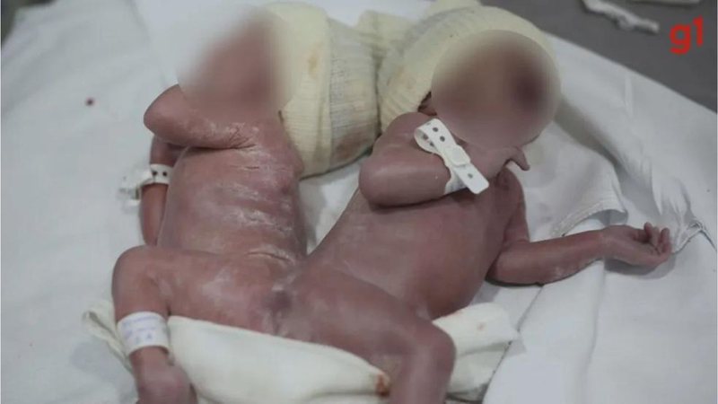 Bebês nasceram unidos pelo osso sacro, na base da coluna vertebral - Divulgação/Hospital do Rocio